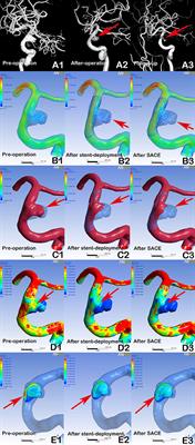 Efficacy of LVIS vs. Enterprise Stent for Endovascular Treatment of Medium-Sized Intracranial Aneurysms: A Hemodynamic Comparison Study